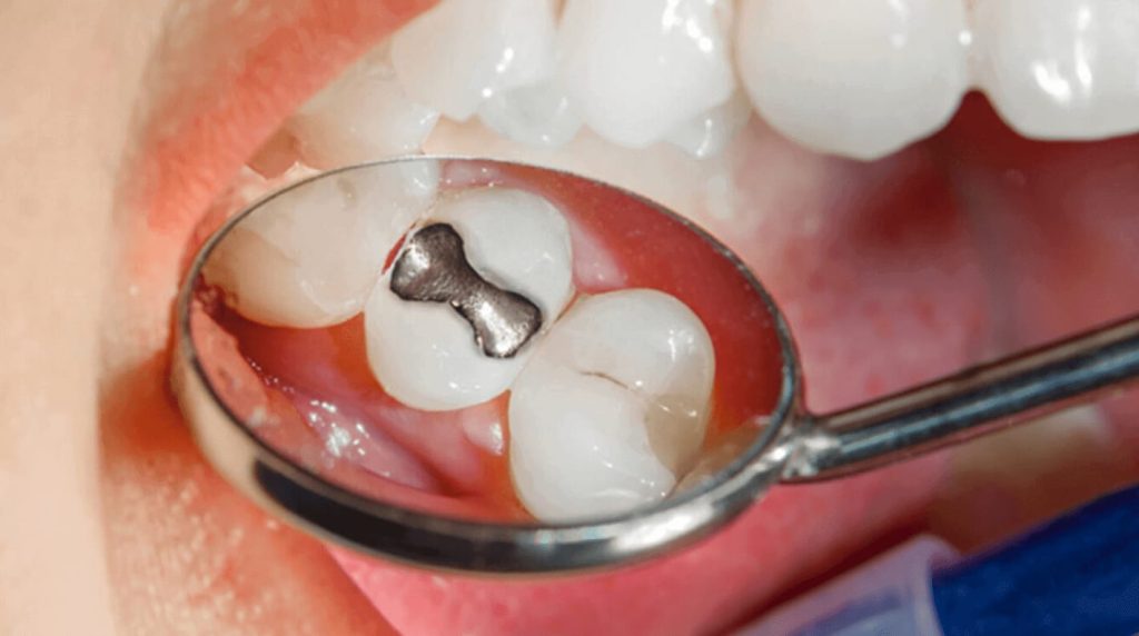 About tooth cavities and its treatment